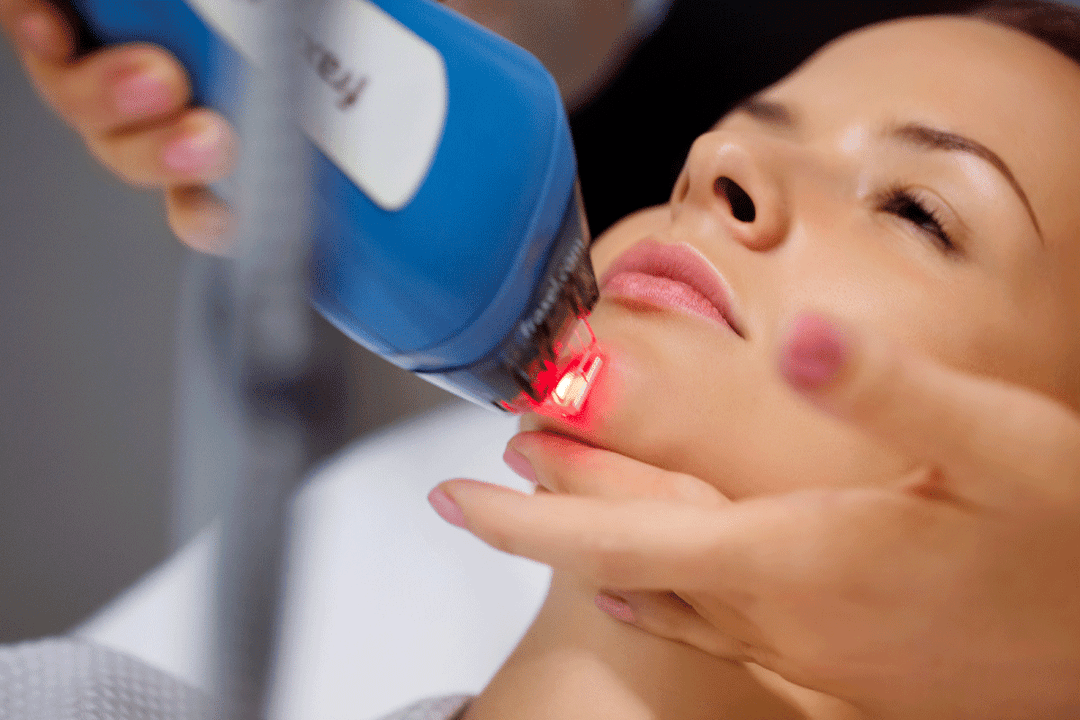 Rajeunissement au laser de la peau du visage