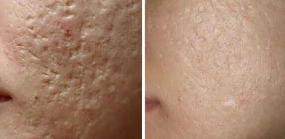 Boucle laser de cicatrices
