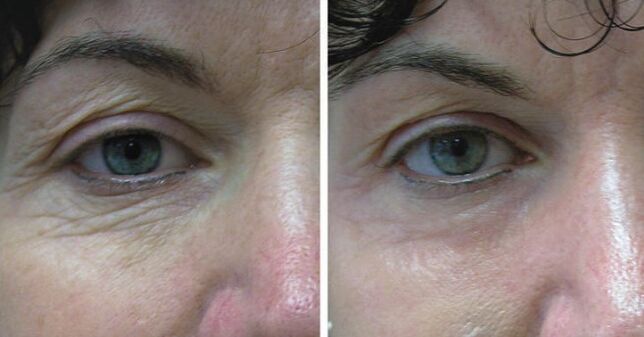Laser de peau autour des yeux