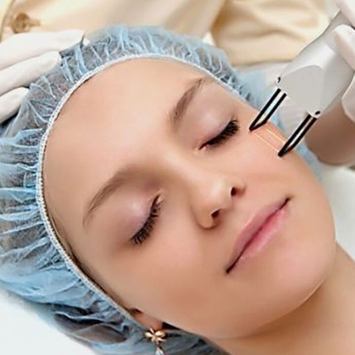 Rajeunissement fractionnaire laser